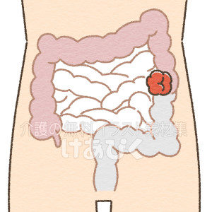 人工肛門（ストーマー）のイラスト