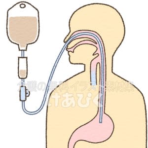経鼻胃管栄養のイラスト